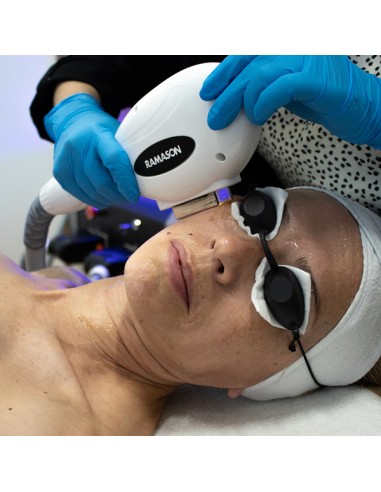 Fotorrejuvenecimiento Facial